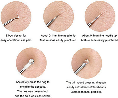 Stainless Steel Blackhead Remover Pimple Blemish Extractor Remover Tool Set